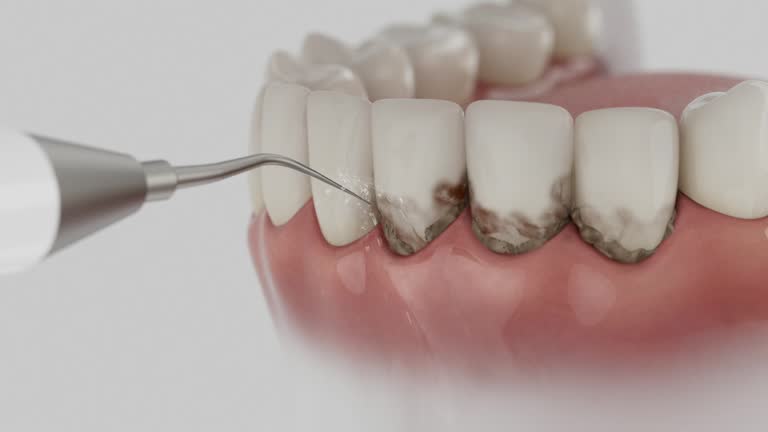 Trusted Wisdom Tooth Removal service in Orland Park, IL - Dentist Open Now